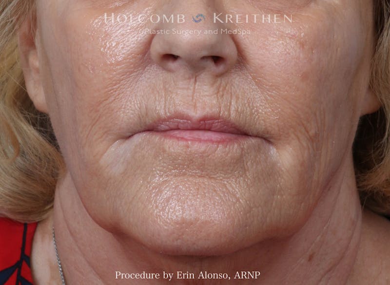 BBL Laser Before & After Gallery - Patient 228757 - Image 3