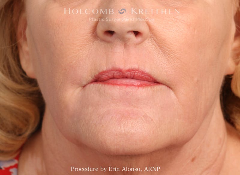 BBL Laser Before & After Gallery - Patient 228757 - Image 4