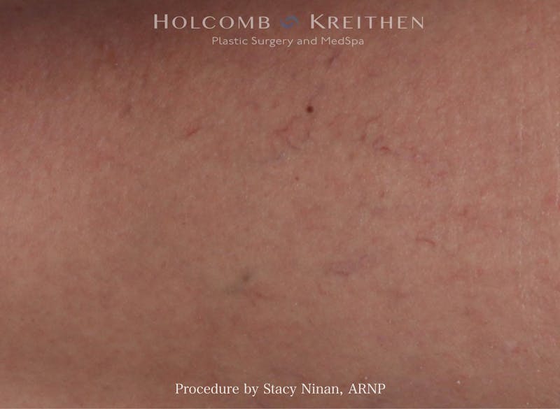 Excel V Before & After Gallery - Patient 402101 - Image 1