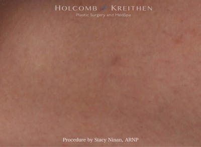 Excel V Before & After Gallery - Patient 402101 - Image 2