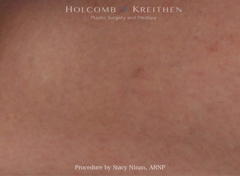 Excel V Before & After Gallery - Patient 402101 - Image 2