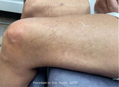Excel V Before & After Gallery - Patient 325656 - Image 1