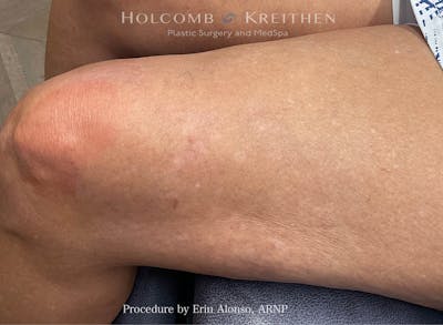 Excel V Before & After Gallery - Patient 325656 - Image 2