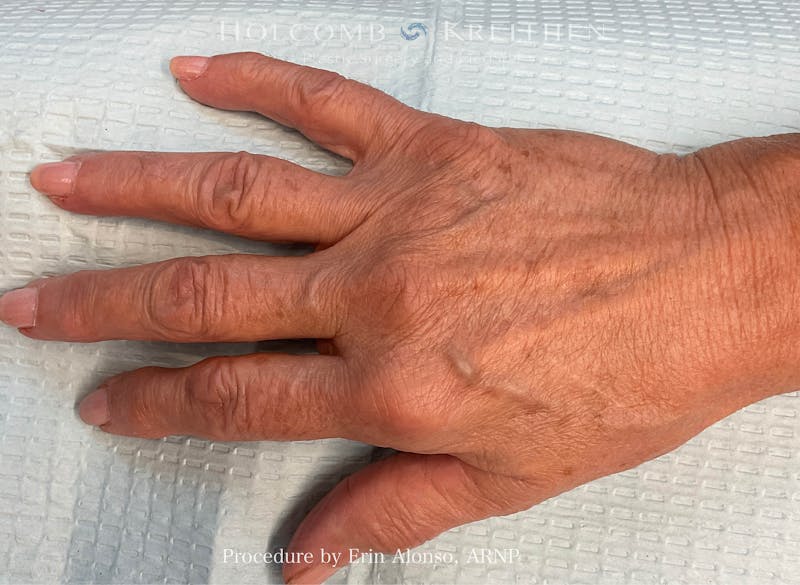 Excel V Before & After Gallery - Patient 289823 - Image 1