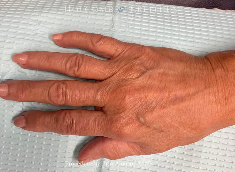 Excel V Before & After Gallery - Patient 289823 - Image 2