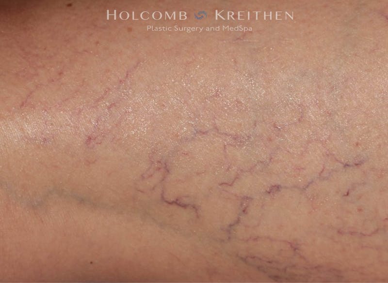 Excel V Before & After Gallery - Patient 757830 - Image 1