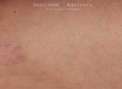 Excel V Before & After Gallery - Patient 757830 - Image 2