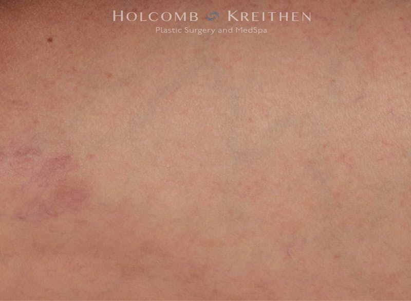 Excel V Before & After Gallery - Patient 757830 - Image 2