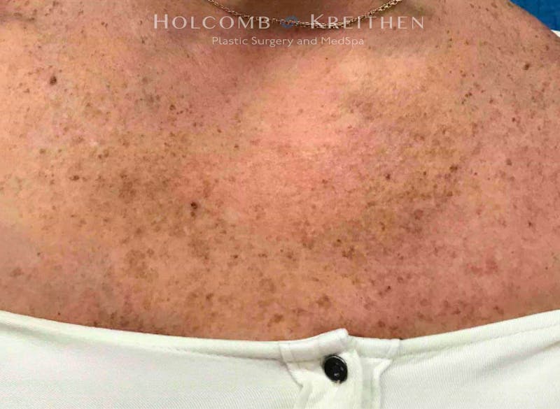 Excel V Before & After Gallery - Patient 258018 - Image 1