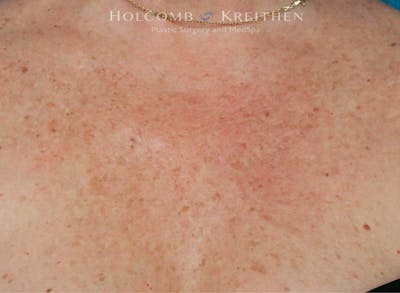 Excel V Before & After Gallery - Patient 258018 - Image 2