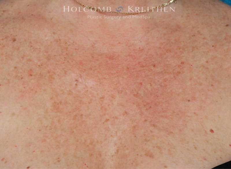 Excel V Before & After Gallery - Patient 258018 - Image 2