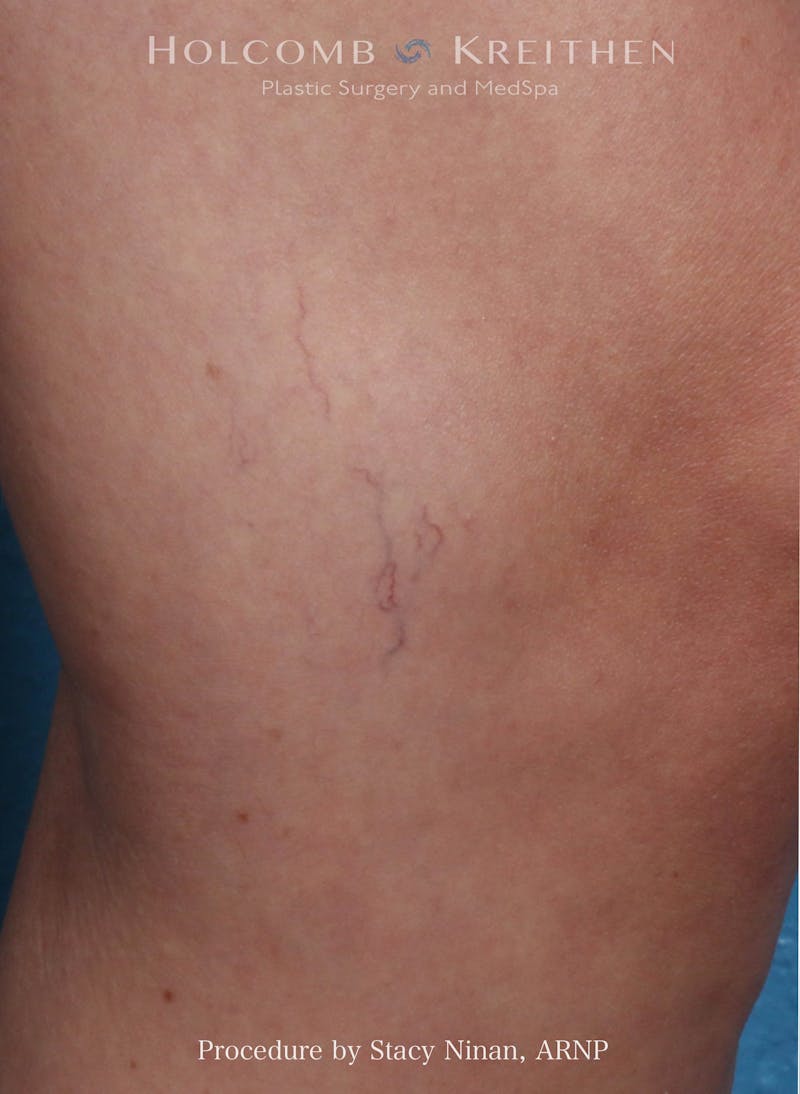Excel V Before & After Gallery - Patient 205888 - Image 1