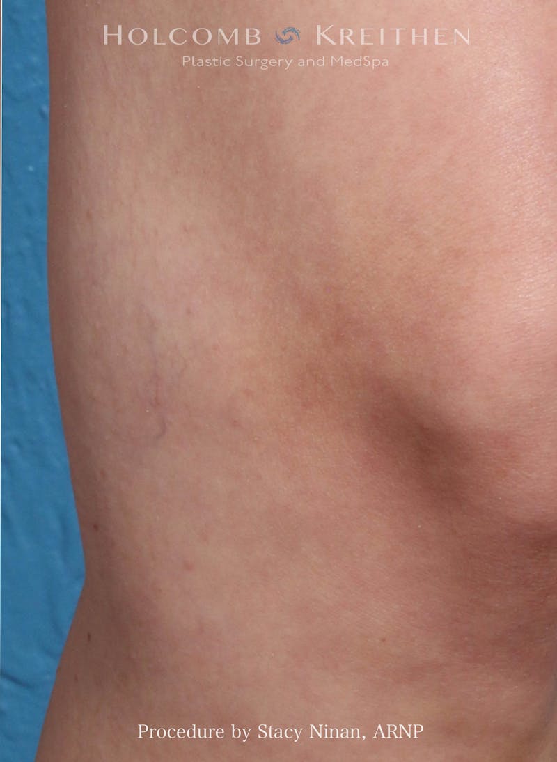 Excel V Before & After Gallery - Patient 205888 - Image 2