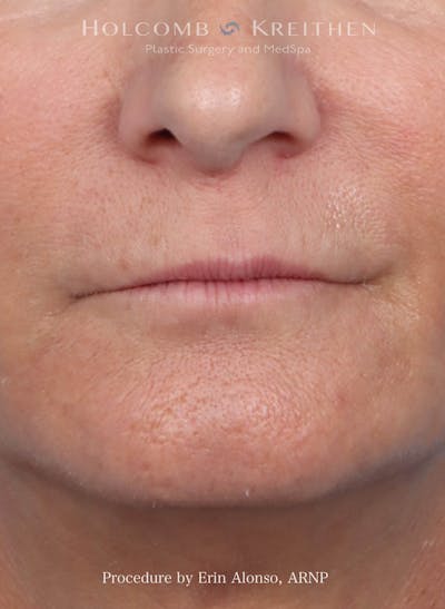 Filler Before & After Gallery - Patient 180365 - Image 1
