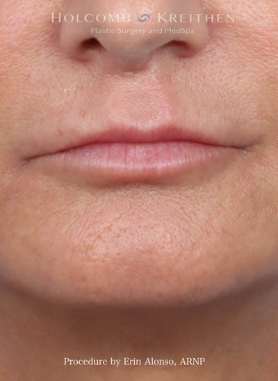 Filler Before & After Gallery - Patient 180365 - Image 2