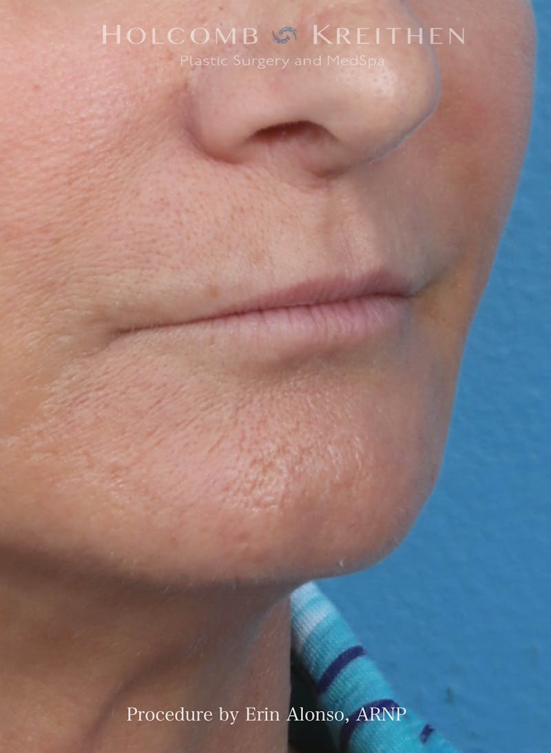 Filler Before & After Gallery - Patient 180365 - Image 3