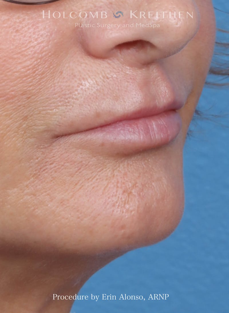 Filler Before & After Gallery - Patient 180365 - Image 4