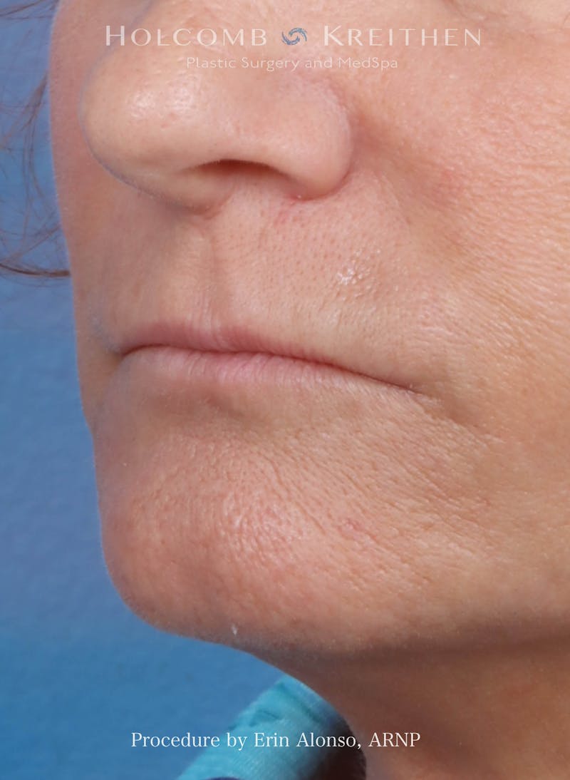 Filler Before & After Gallery - Patient 180365 - Image 5