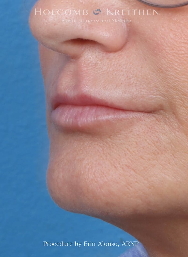 Filler Before & After Gallery - Patient 180365 - Image 6