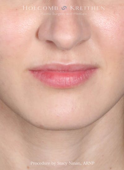 Filler Before & After Gallery - Patient 314670 - Image 1