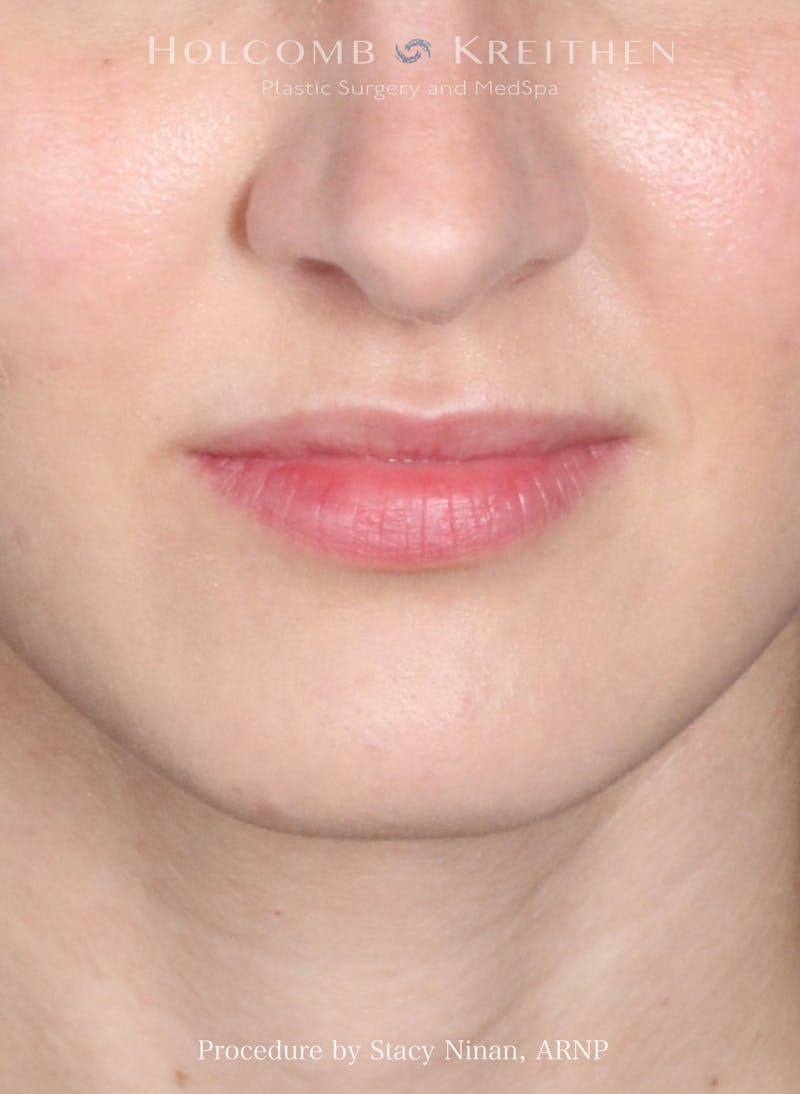 Filler Before & After Gallery - Patient 314670 - Image 1