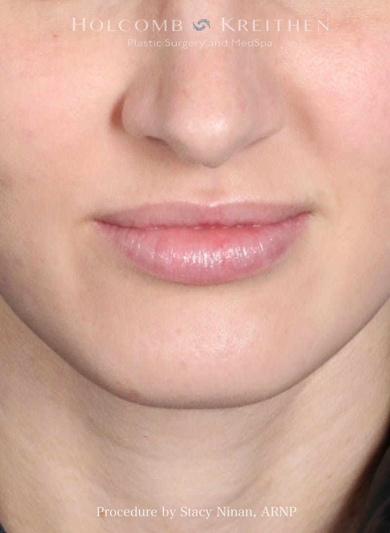 Filler Before & After Gallery - Patient 314670 - Image 2