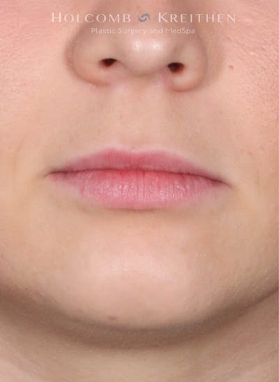 Filler Before & After Gallery - Patient 761777 - Image 1