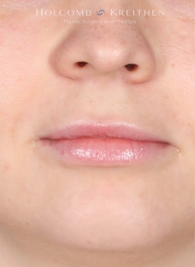 Filler Before & After Gallery - Patient 761777 - Image 2
