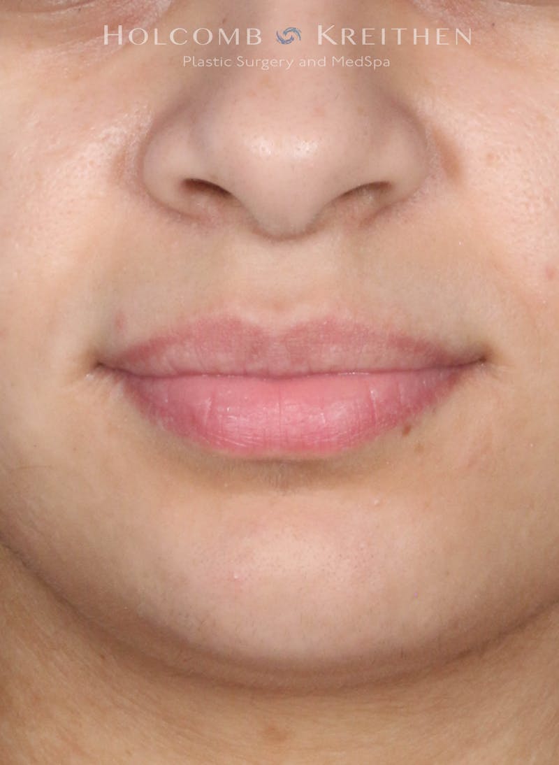 Filler Before & After Gallery - Patient 284484 - Image 1