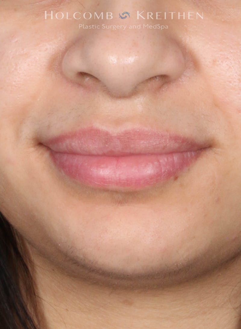 Filler Before & After Gallery - Patient 284484 - Image 2