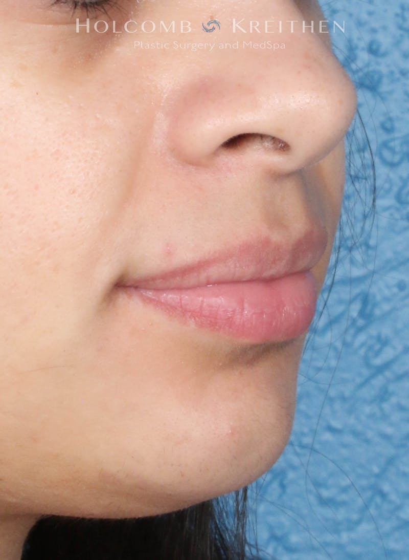 Filler Before & After Gallery - Patient 284484 - Image 3