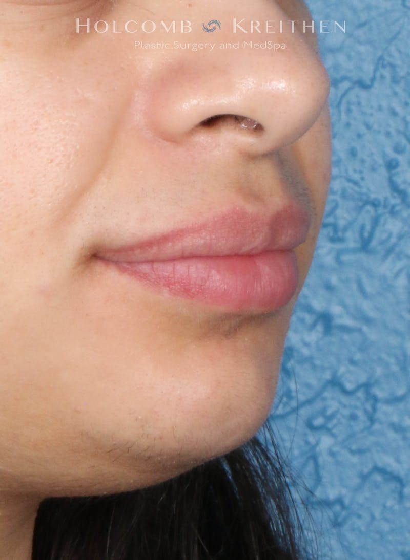 Filler Before & After Gallery - Patient 284484 - Image 4