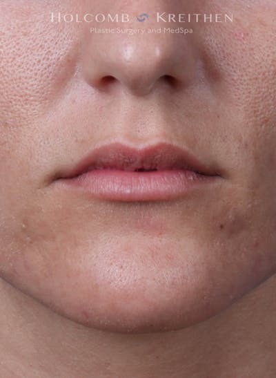 Filler Before & After Gallery - Patient 233868 - Image 1