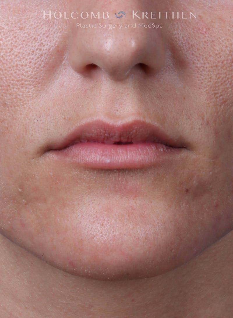 Filler Before & After Gallery - Patient 233868 - Image 1