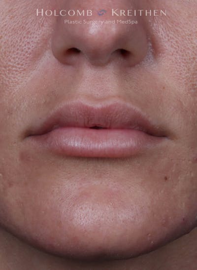 Filler Before & After Gallery - Patient 233868 - Image 2