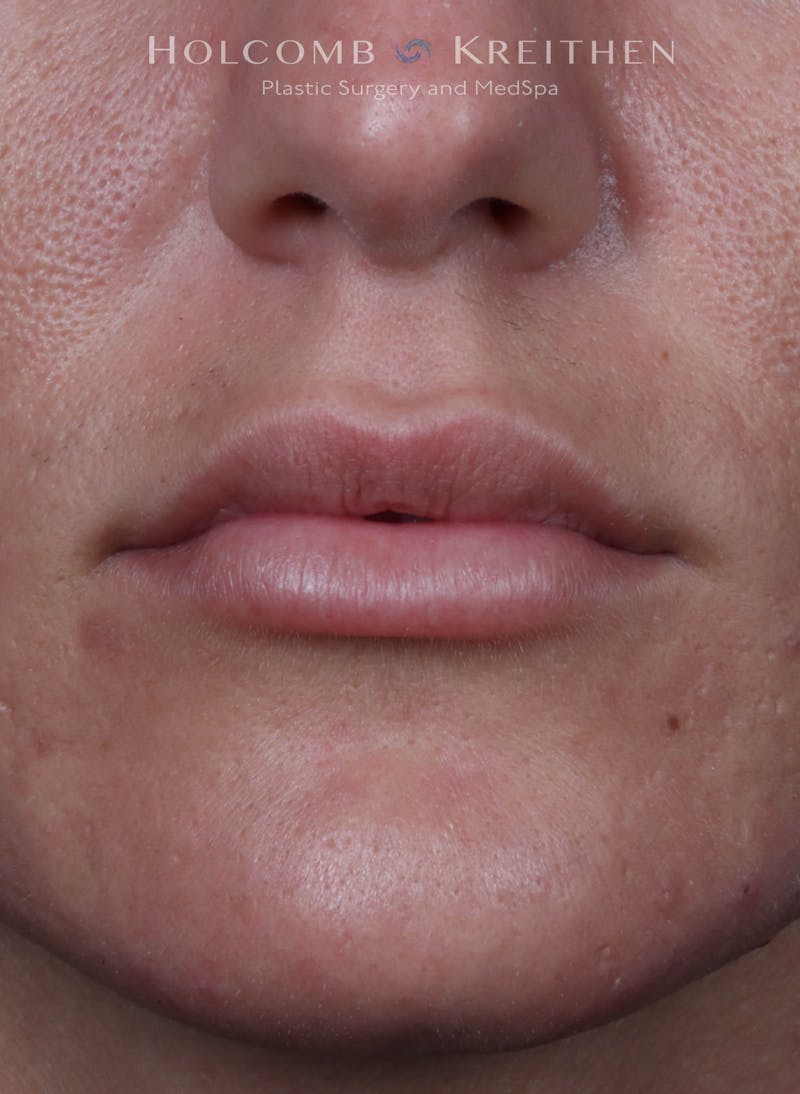 Filler Before & After Gallery - Patient 233868 - Image 2