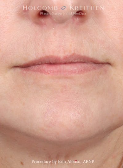 Filler Before & After Gallery - Patient 312963 - Image 1