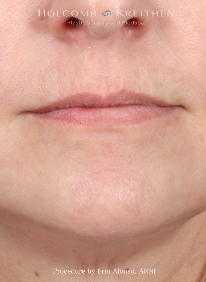 Filler Before & After Gallery - Patient 312963 - Image 1