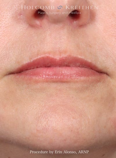 Filler Before & After Gallery - Patient 312963 - Image 2