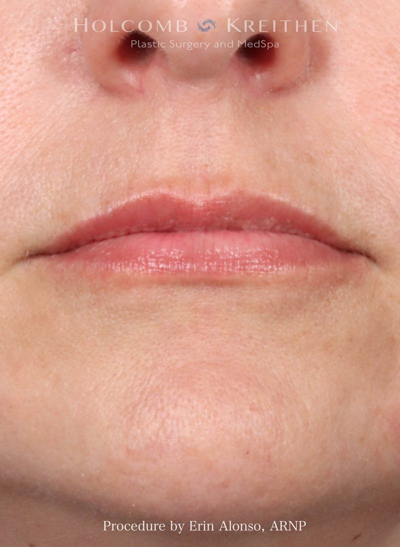 Filler Before & After Gallery - Patient 312963 - Image 2