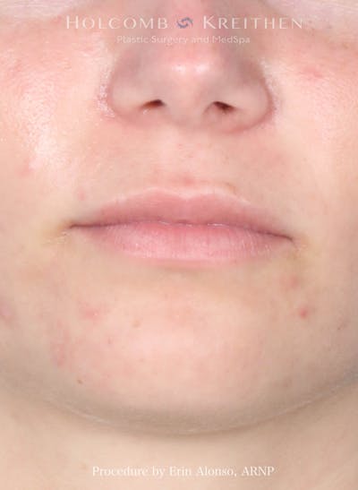 Filler Before & After Gallery - Patient 352677 - Image 1