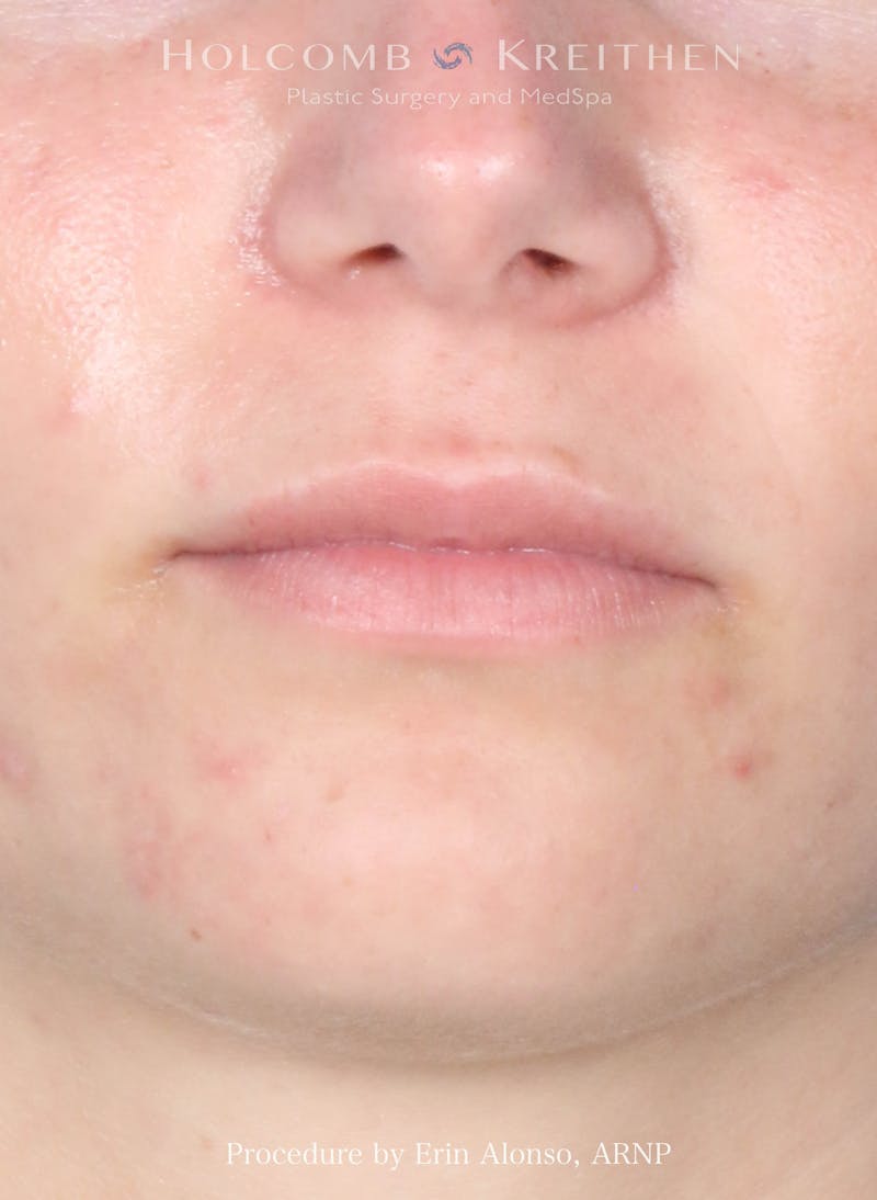 Filler Before & After Gallery - Patient 352677 - Image 1