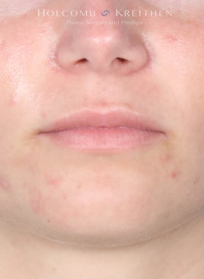 Filler Before & After Gallery - Patient 352677 - Image 2