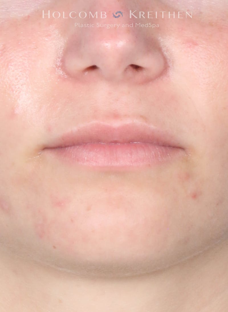Filler Before & After Gallery - Patient 352677 - Image 2