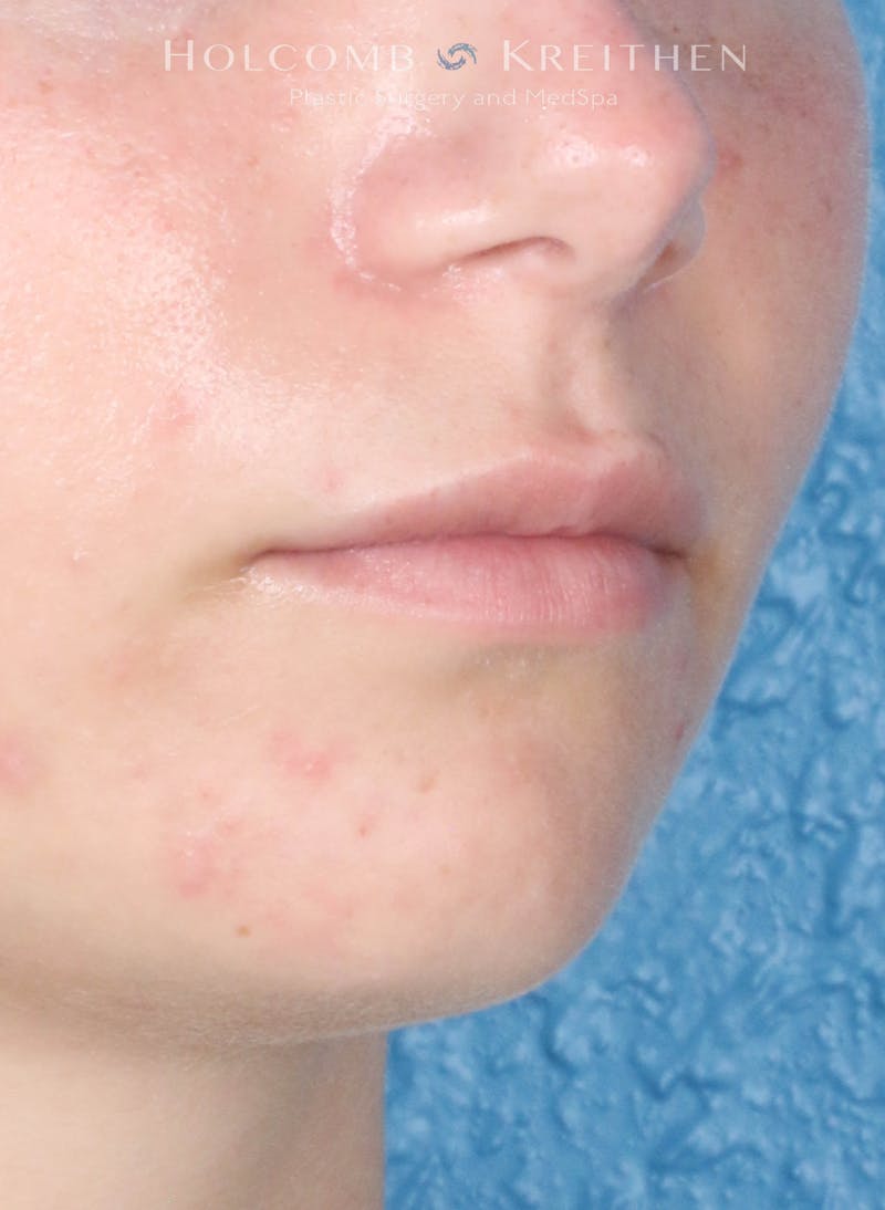 Filler Before & After Gallery - Patient 352677 - Image 3