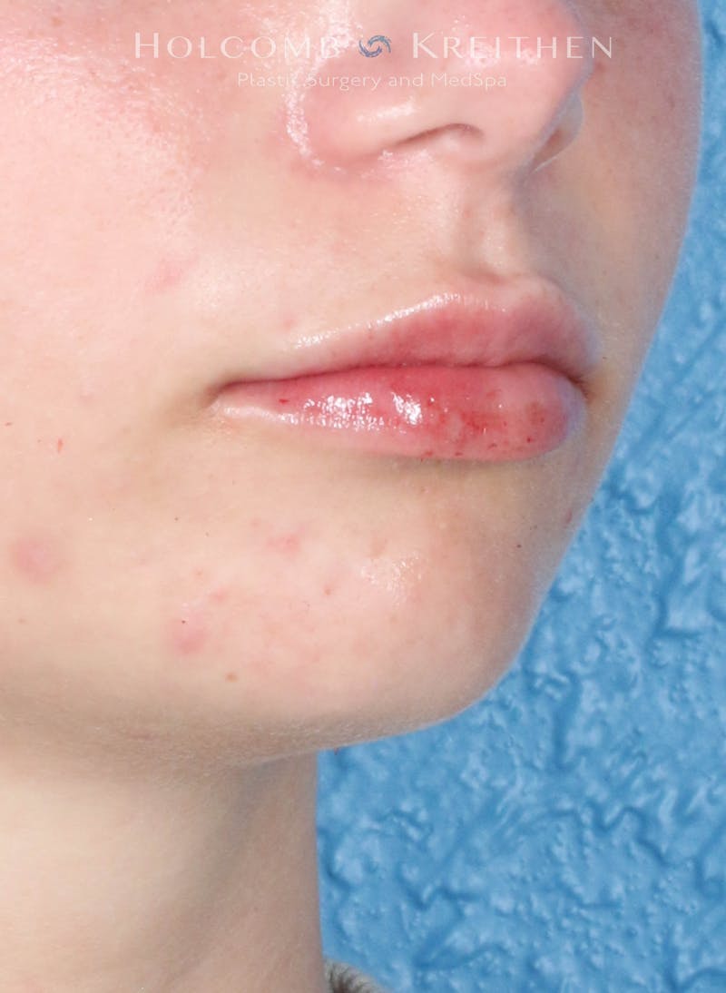 Filler Before & After Gallery - Patient 352677 - Image 4