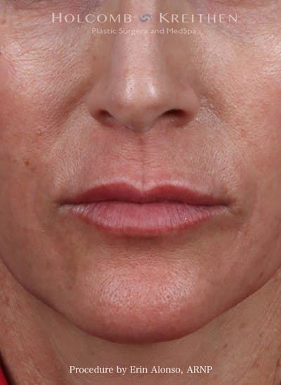 Filler Before & After Gallery - Patient 207381 - Image 1