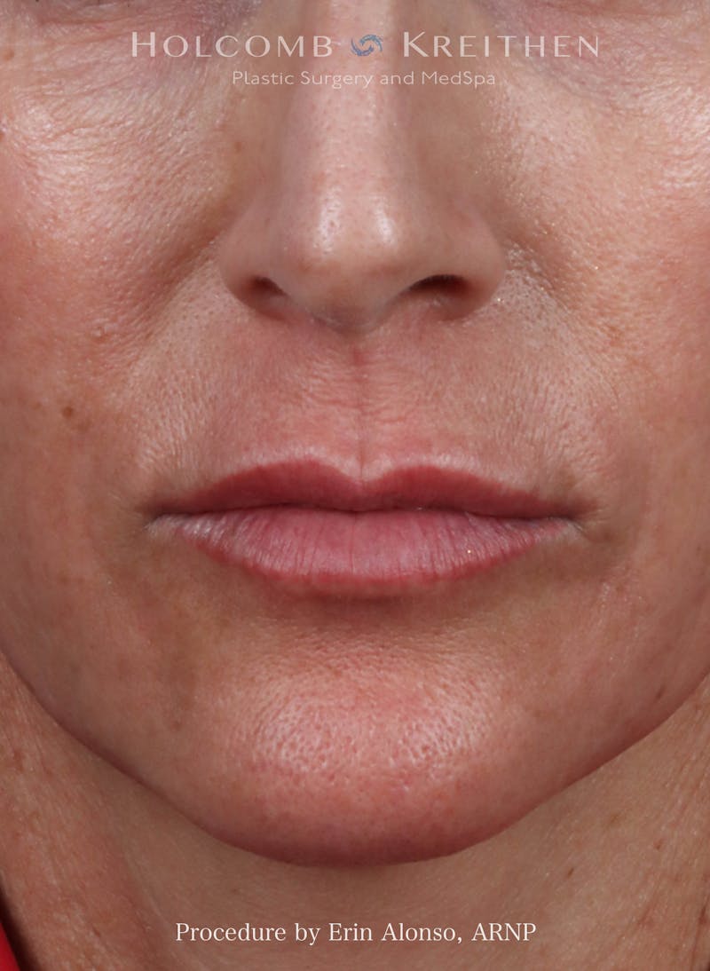 Filler Before & After Gallery - Patient 207381 - Image 1