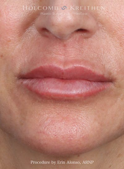 Filler Before & After Gallery - Patient 207381 - Image 2