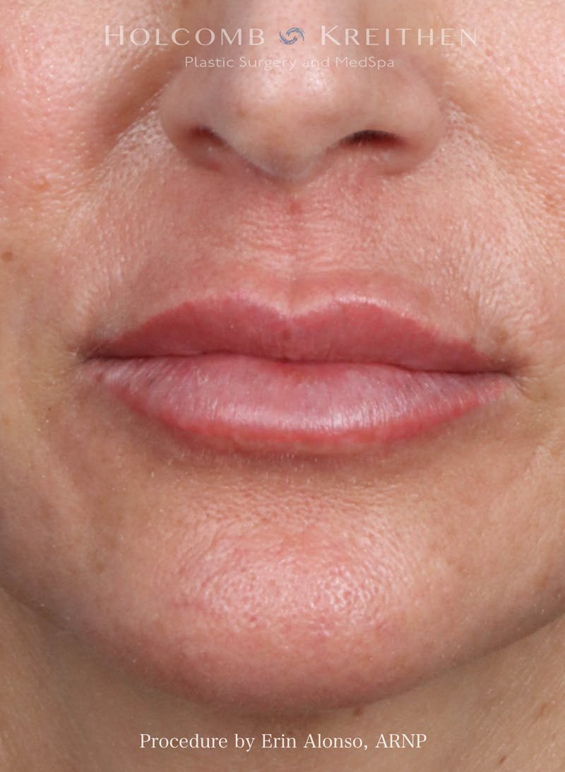 Filler Before & After Gallery - Patient 207381 - Image 2
